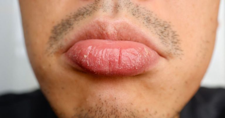 fix chapped lips