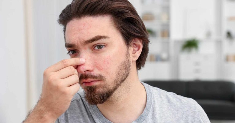 homme souffrant d'acné kystique