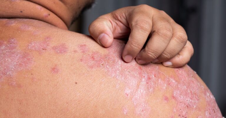 Inflammatory Skin Conditions​